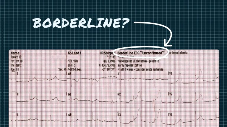 What Can Cause A Borderline ECG? Key Triggers To Know