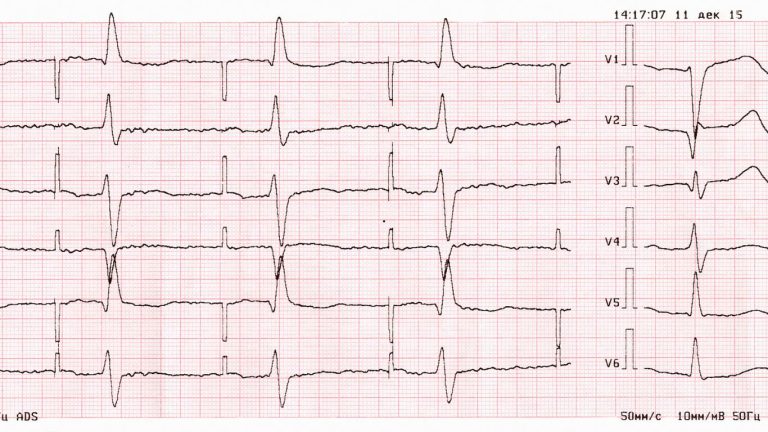 Is Your Upside Down Qrs Complex A Silent Killer - ak2i6ww